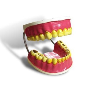 흡연으로 인해 변색된 치아 모형[KIM3-18]