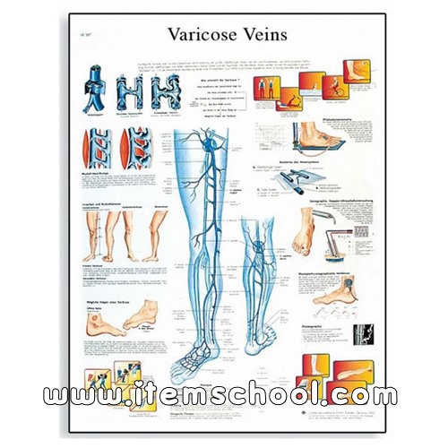 정맥류 차트 Varicose Veins Chart VR1367UU [4006684]